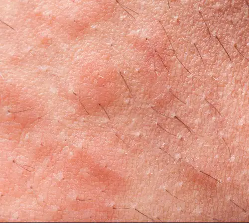 Seborrheic%20dermatitis 004 w