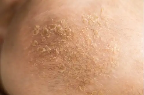 Psoriasis%20Treatment 004 w